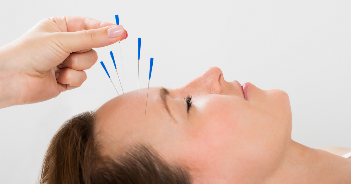A Guide to Acupuncture Practice and Its Benefits